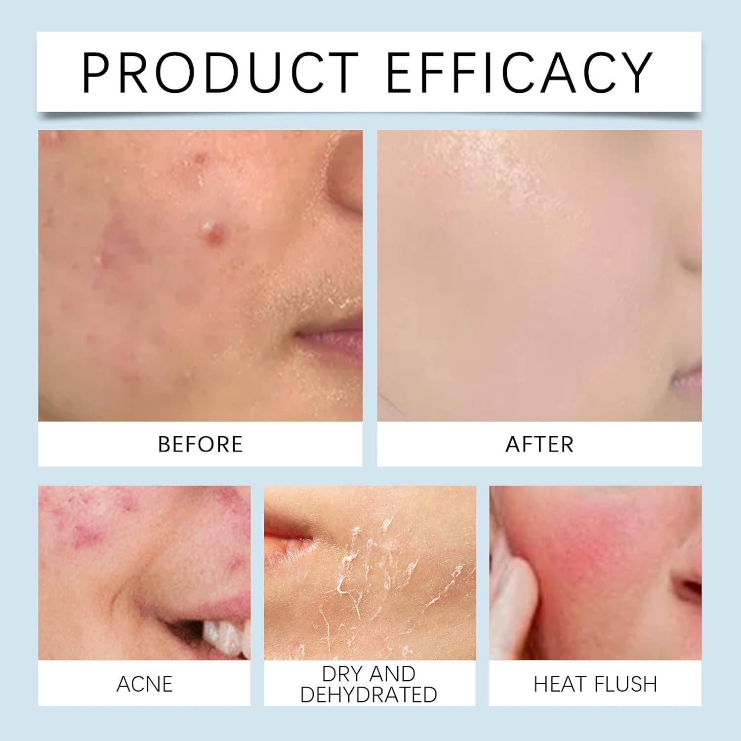 Hyaluronic Acid Microneedling Serum, Hyaluronic Acid Serum, Gla-Mory Micro-Infusion Facial System, Hyaluronic Acid Micro Needling Roller, Hyaluronic Acid Face Serum for Women, Hydrating, anti Wrinkle